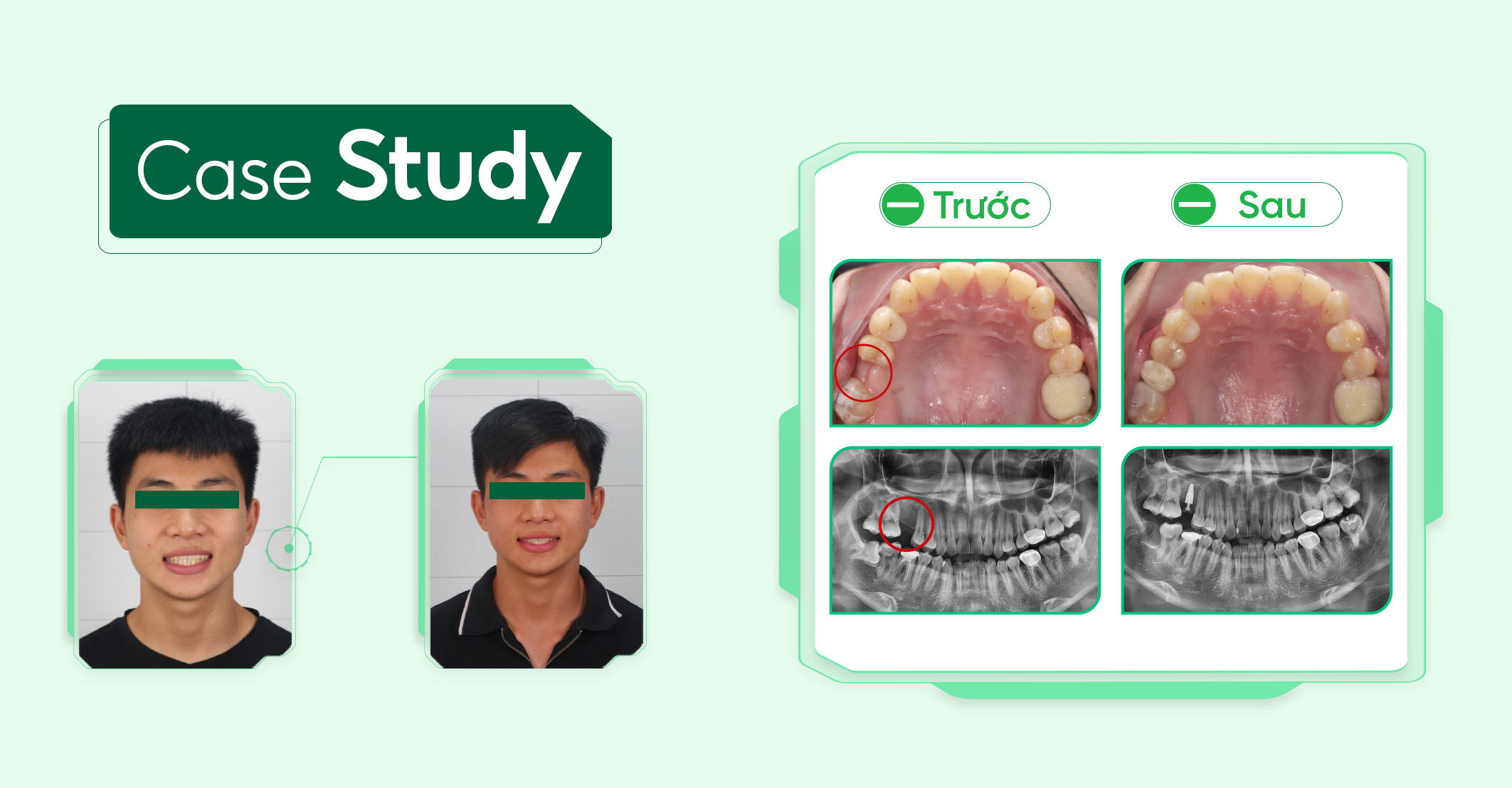 Case-implant-1-rang (2)