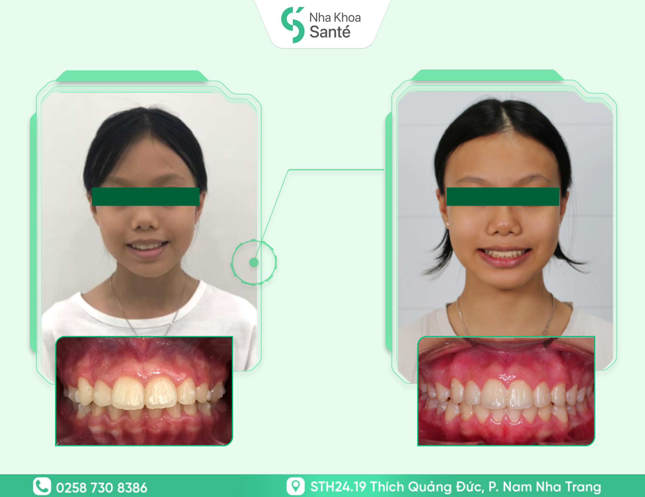 Nguyễn Ngọc Thảo Như - Invisalign
