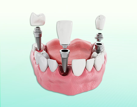 avata-implant-vai-rang (1)